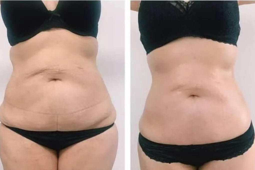 Biolift Regen – fala radiowa - lifting brzucha