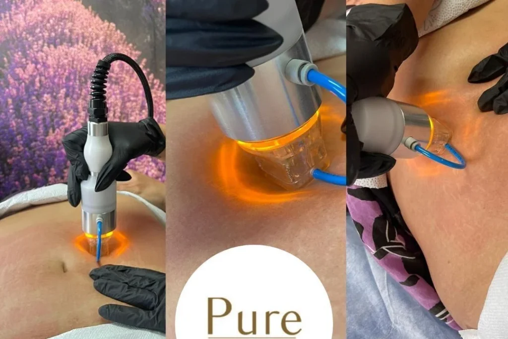 Radiofrekwencja mikroigłowa zabieg 1