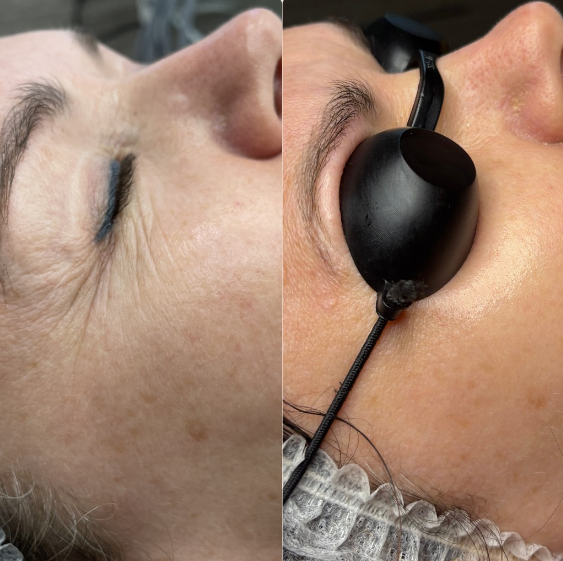 Laser Tulowy Rzeszów