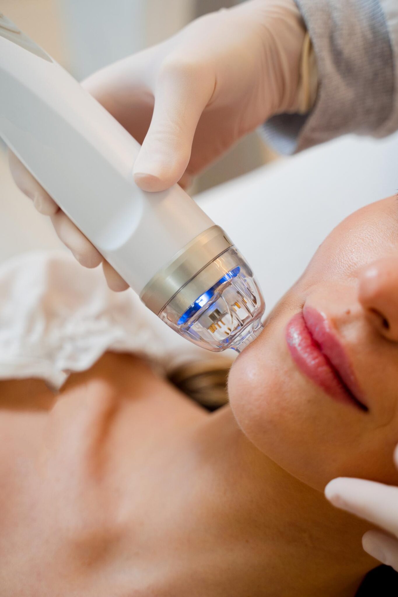 Radiofrekwencja mikroigłowa